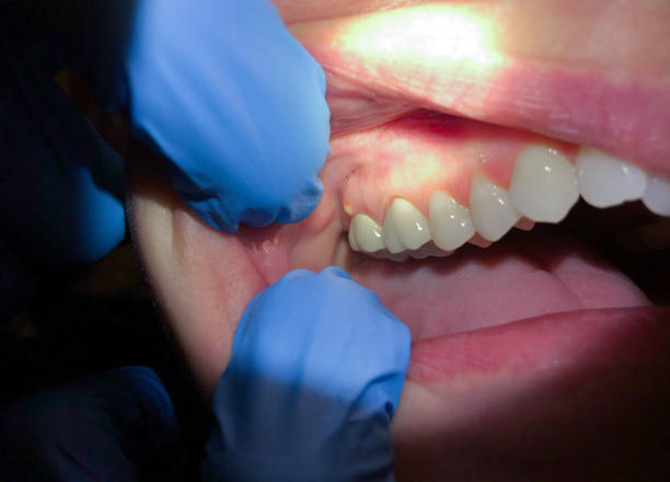 Best Broken or Cracked Tooth Emergency Dentist in Bluff City, TN